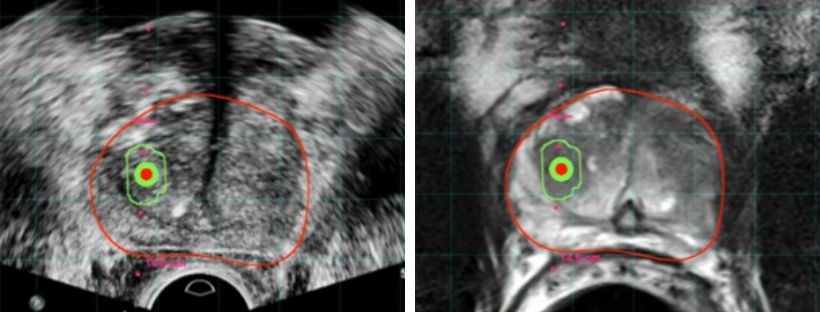 Tumore alla prostata. ECO fusion, approccio diagnostico innovativo