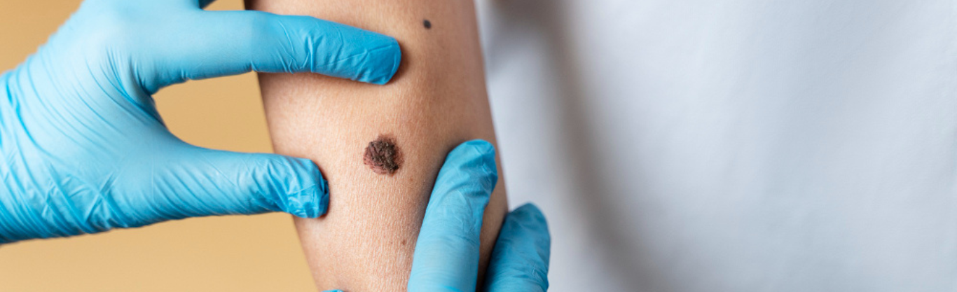 Melanoma cutaneo: sintomi, prevenzione, diagnosi e trattamento