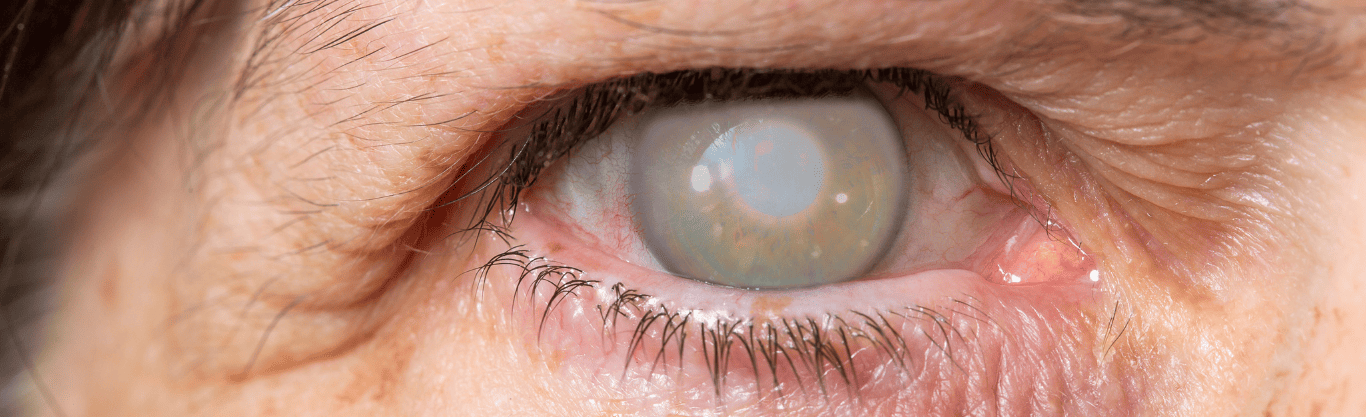 Cos’è il glaucoma e come si manifesta?