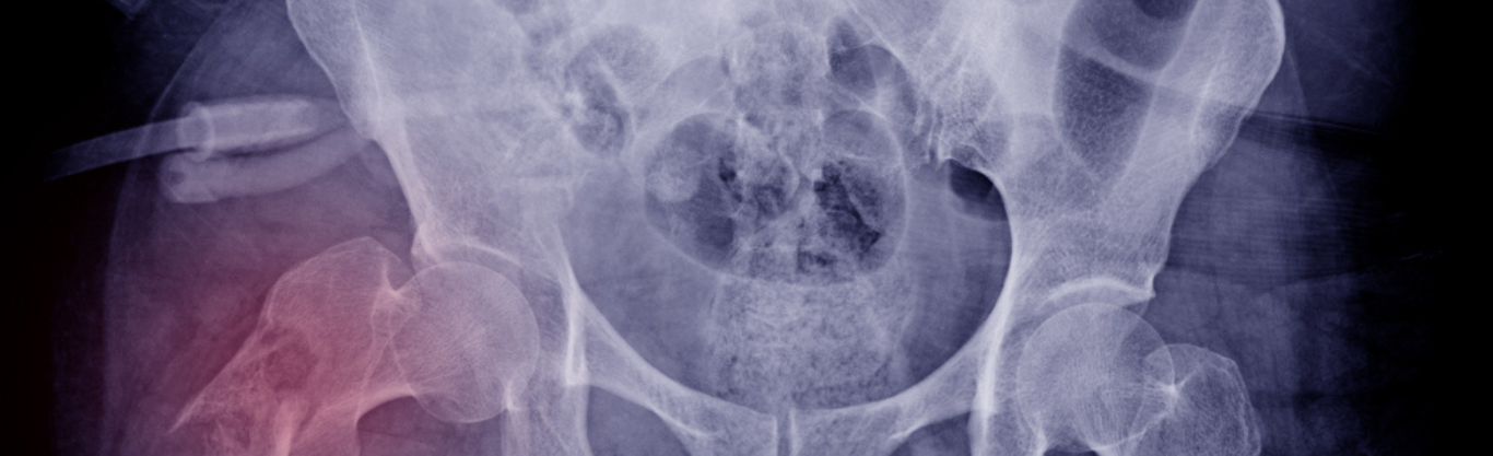 Ridurre il rischio di fratture: cresce l’impegno del San Camillo nel trattamento dell’osteoporosi