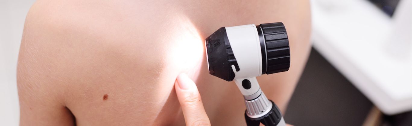 Melanoma cutaneo: sintomi, prevenzione, diagnosi e trattamento